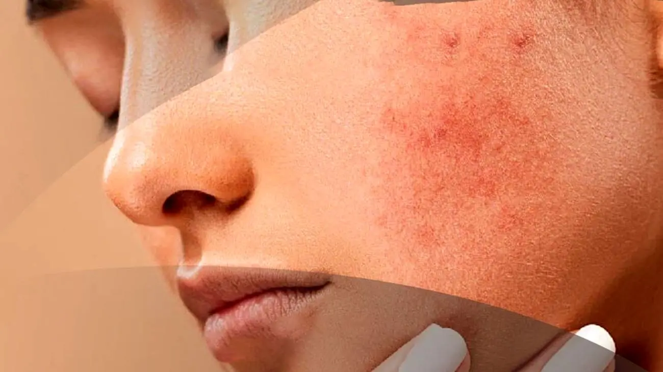 دلیل دانه های قرمز بدون خارش روی پوستم