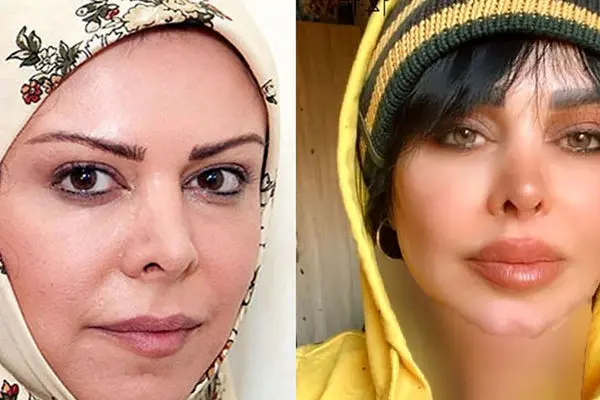  تغییر چهره خانم بازیگر سرشناس ایرانی بعد از جدیدترین تزریق ژل / فلور 20 سال جوان شد !